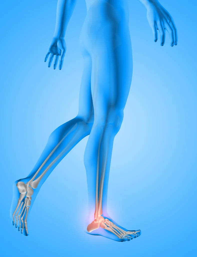 fascitis plantar en verano causas y consejos
